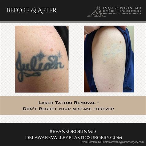 Dermabrasion for tattoo removal