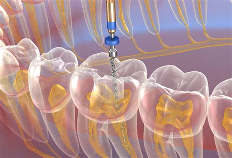 Endodontic Surgery