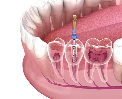 Endodontic Treatment Planning