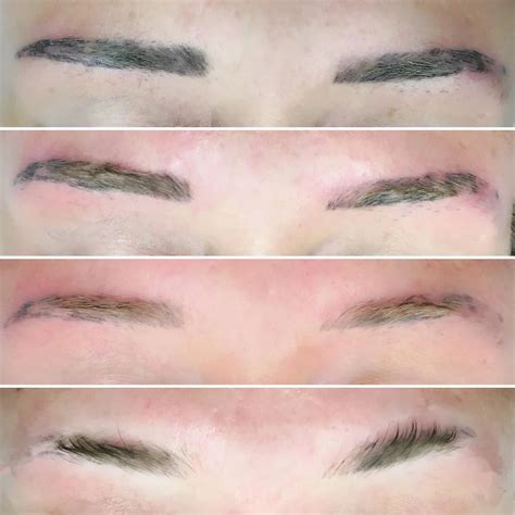 Eyebrow tattoo removal process