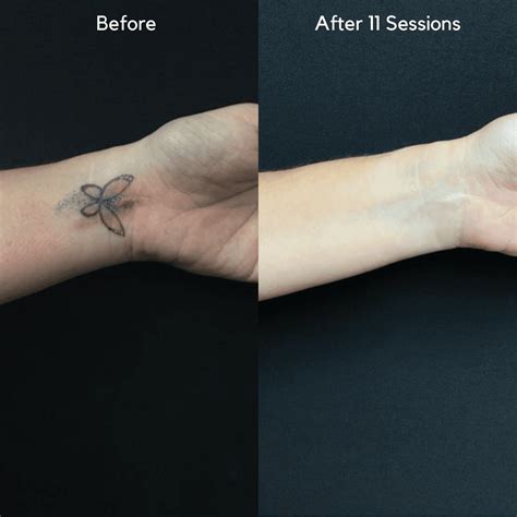 Fine line tattoo removal process