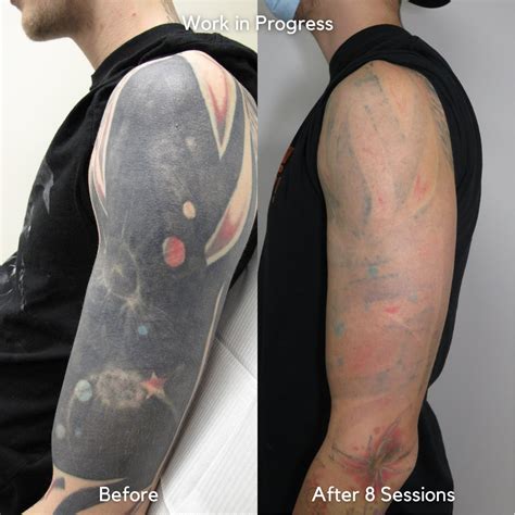 Full sleeve tattoo removal