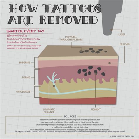 How Tattoo Removal Works