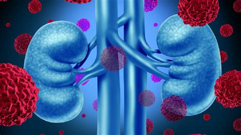 Insuficiencia renal