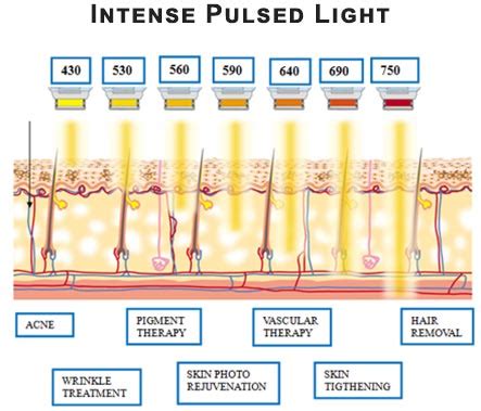 Intense pulsed light therapy method