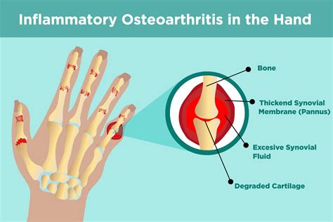 Joint Pain