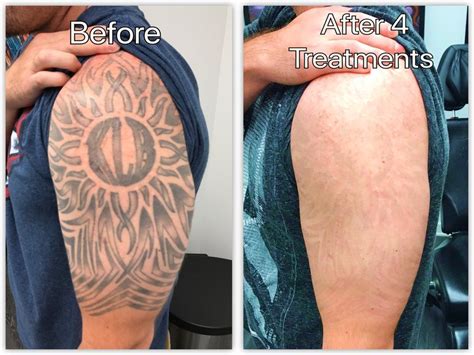 Laser tattoo removal before and after