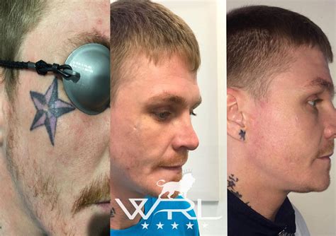 Laser tattoo removal before and after