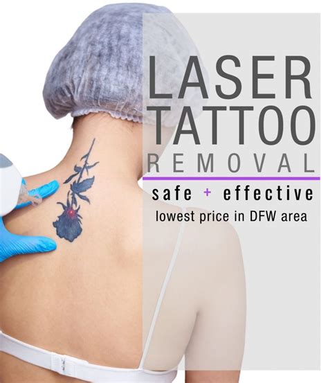 Laser tattoo removal in Dallas