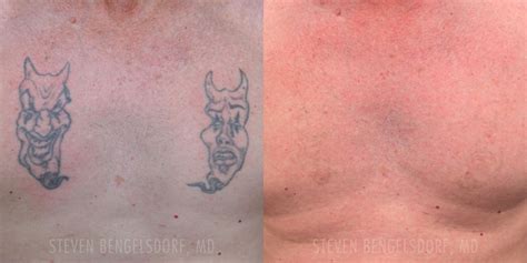 Laser tattoo removal