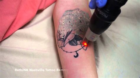 Laser tattoo removal