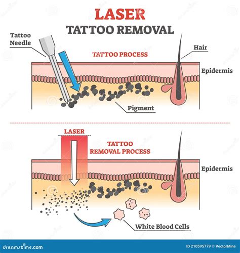 Description of Laser Tattoo Removal Process