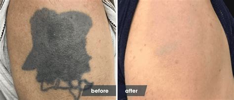 Recovery after laser tattoo removal