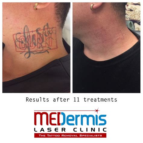 Laser tattoo removal results