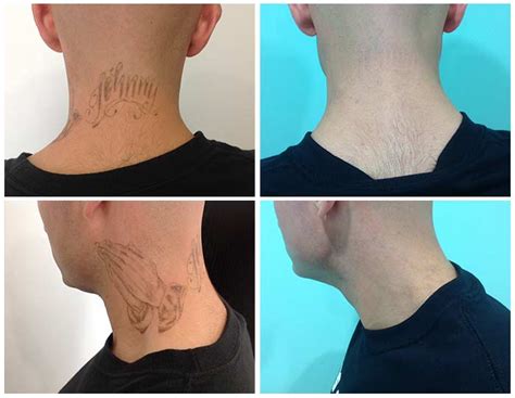 Laser Tattoo Removal Tijuana