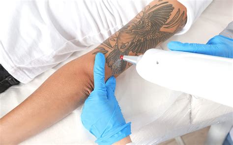 Description of Laser Tattoo Removal Tips