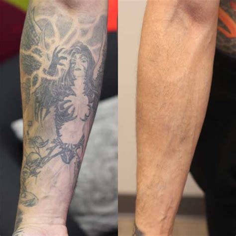 lower arm sleeve tattoo removal