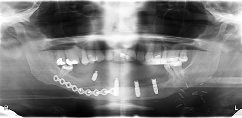 Maxillofacial reconstruction procedure