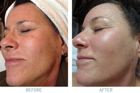 Microdermabrasion and Chemical Peels