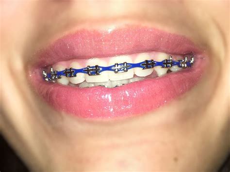 Navy Blue Braces Options