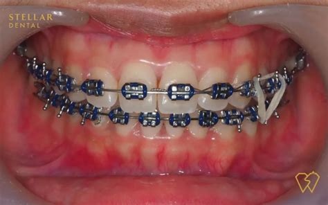 Navy Blue Braces and Orthodontic Treatment