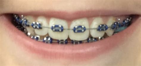 Navy Blue Braces Before and After