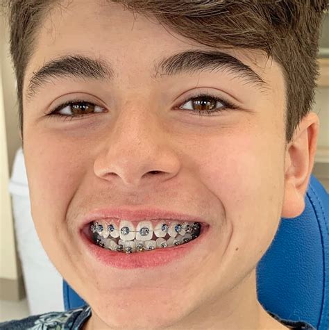 Navy Blue Braces for Kids