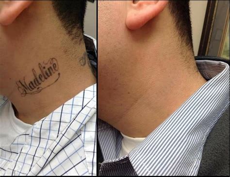 Neck tattoo removal for guys