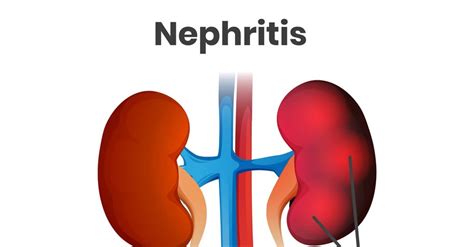 Nefritis