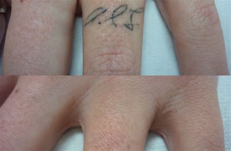 Non-Laser Tattoo Removal Techniques