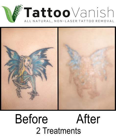 Non-laser tattoo removal methods