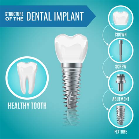 Oral Maxillofacial Surgeon Implant