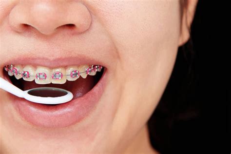 Orthodontic Treatment