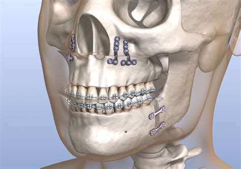 Orthognathic surgery procedure