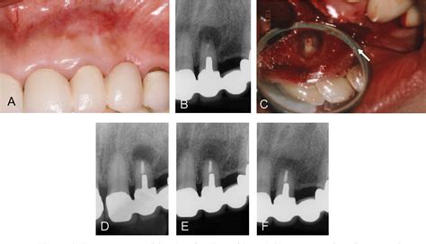 Periradicular Surgery