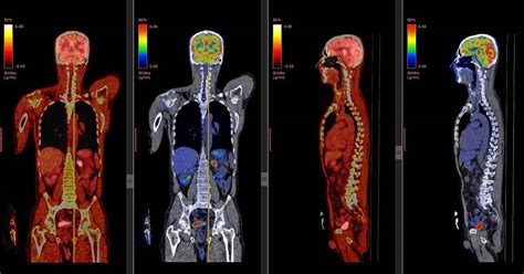 PET Scan