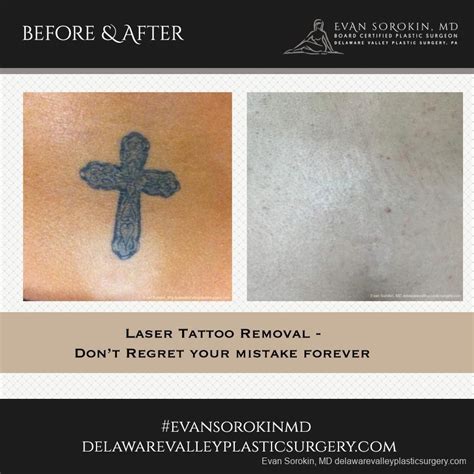 Philadelphia Tattoo Removal Experts