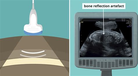 Physical Demands of Sonography