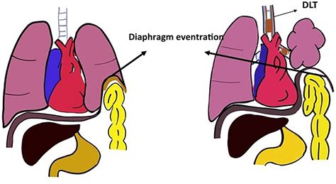 Placation