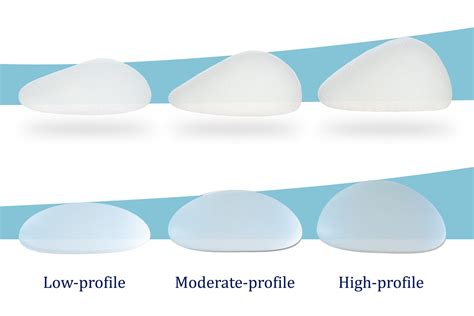 Reserve Augmentation Profile