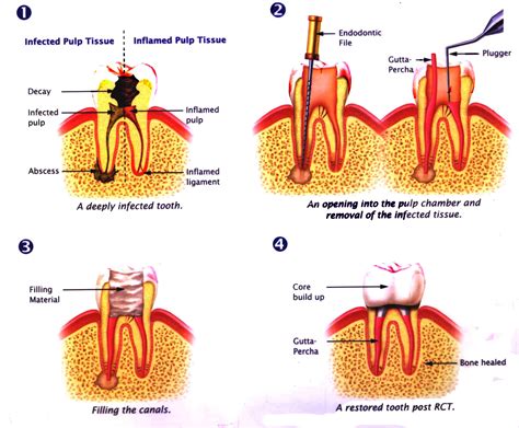 Root Canal Procedure