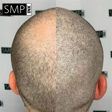 Scalp micropigmentation