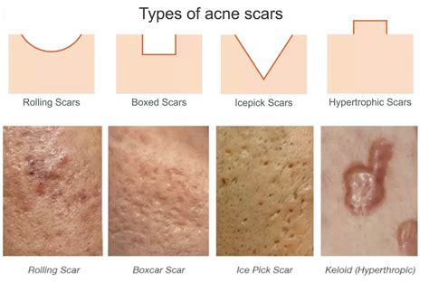 Scar Coverage for Different Skin Types