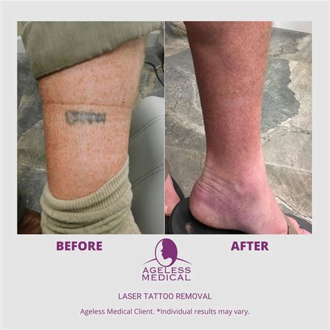 Scars and tattoo removal