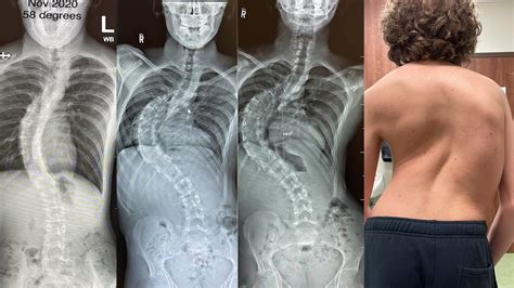 Severe Scoliosis