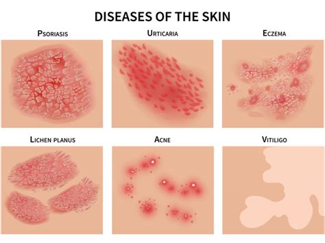 Severe Skin Conditions