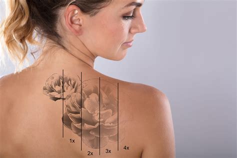 Shoulder Tattoo Removal