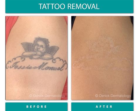 small tattoo removal