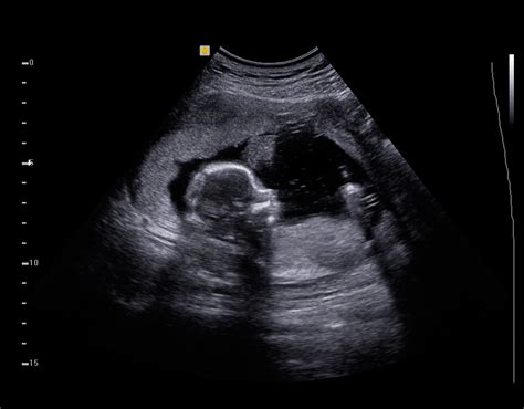 Sonogram Image