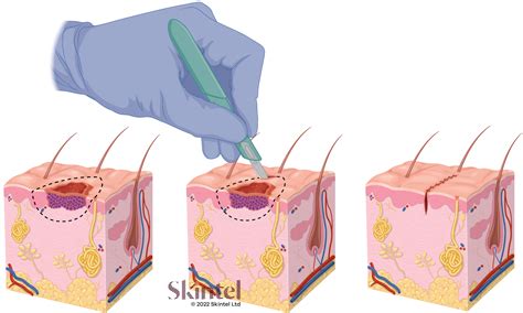 Surgical excision method